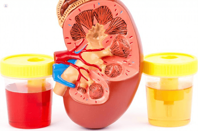 hematuria-o-sangre-en-la-orina-diagnostico-y-tratamiento