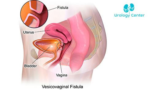 que-sabe-sobre-la-fistula-vesicovaginal