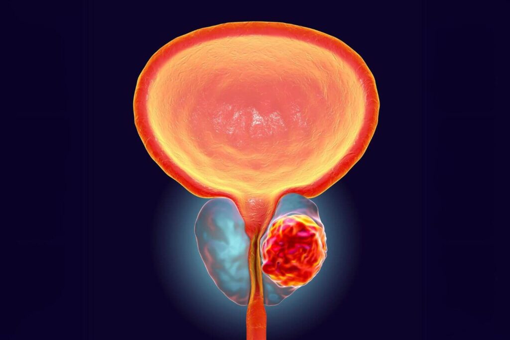 Mitos sobre el cáncer de próstata